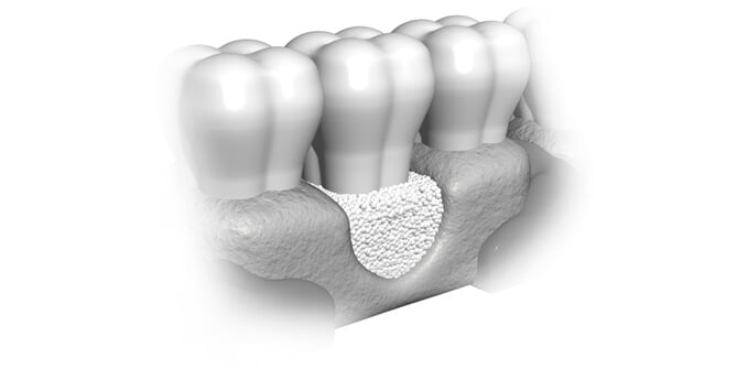 Bone Grafting Techniques