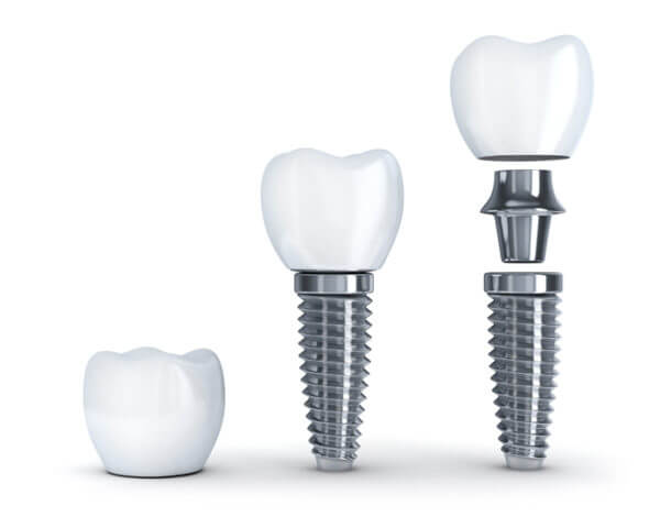 Dental Implant Sizes