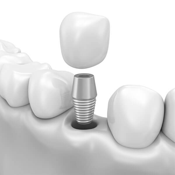 Traditional Dental Implant Procedure