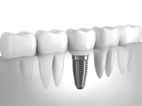 Dental Implants