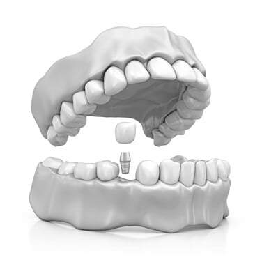 Dental Implants Placing Procedure