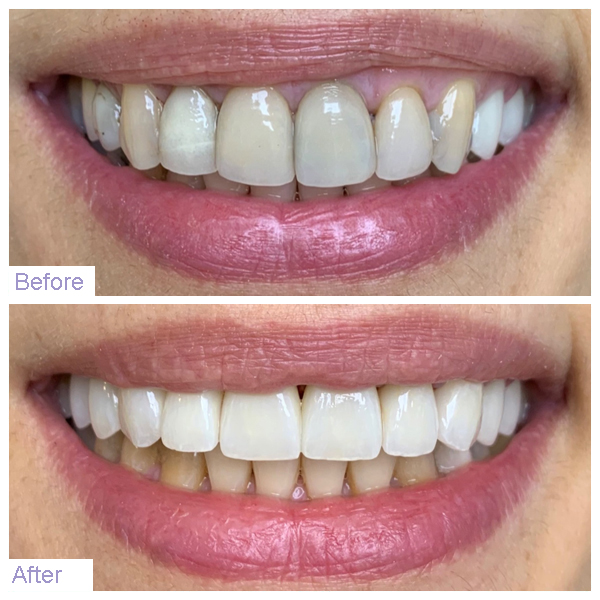 Smile Before and After Dental Implants Procedure